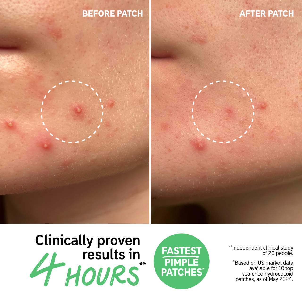 Hydrocolloid Pimple Patches