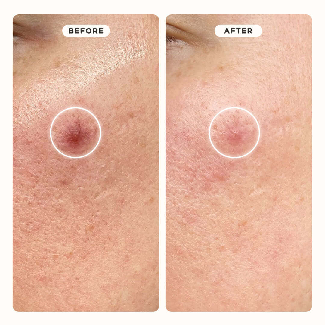 Hydrocolloid Pimple Patches